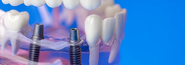 General-Dentistry-Dental-Bridges-Multi-CS1.webp General-Dentistry-Dental-Bridges-Multi-CS1.webp