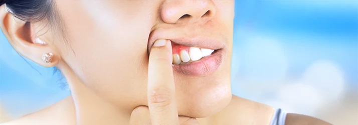 Close up of the bottom half of a clean face with a finger pushing up the top corner of the upper lip to reveal the gum line Close up of the bottom half of a clean face with a finger pushing up the top corner of the upper lip to reveal the gum line