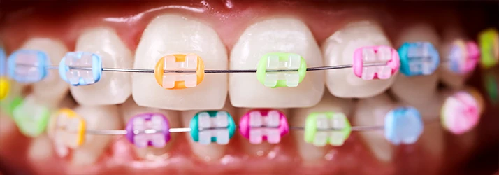 Close-up of teeth with ceramic braces and colorful orthodontic bands, illustrating personalized orthodontic treatment.