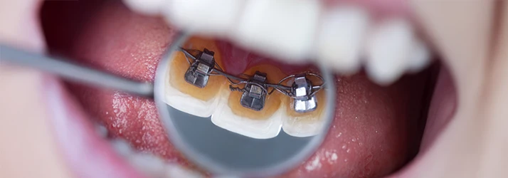 Close-up dental mirror view of lingual braces installed behind teeth, illustrating discreet orthodontic treatment.