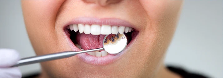 Close-up of orthodontist examining teeth with lingual braces, using a dental mirror to show discreet orthodontic treatment. Close-up of orthodontist examining teeth with lingual braces, using a dental mirror to show discreet orthodontic treatment.
