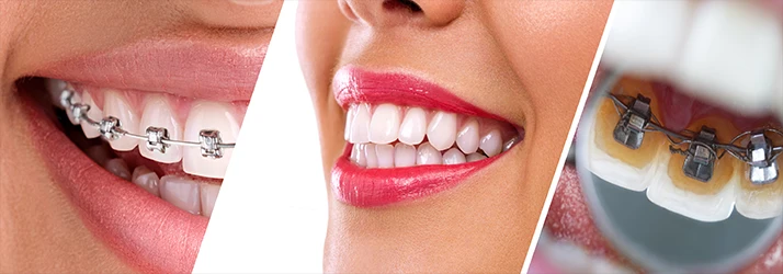 Close-ups of orthodontic braces and straight teeth demonstrating treatment results.