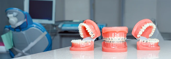 Dental models displaying different types of orthodontic braces placed on a counter in a modern orthodontics office.