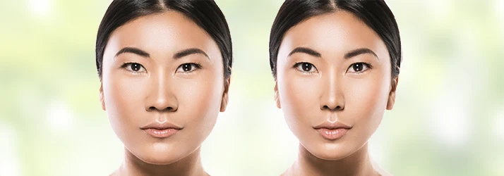 Before and after of someone who had Orthognathic Surgery Before and after of someone who had Orthognathic Surgery