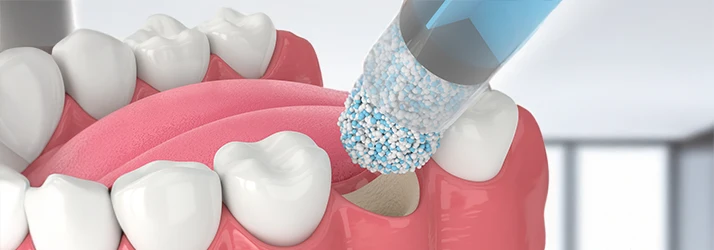 Detailed image of bone grafting procedure for dental implants by oral surgeon.