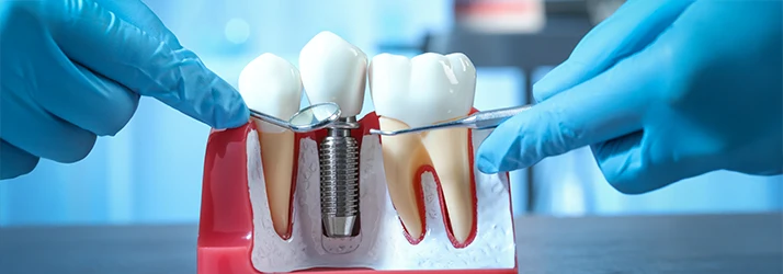 Dental implant model demonstrating oral surgery procedure for tooth replacement.