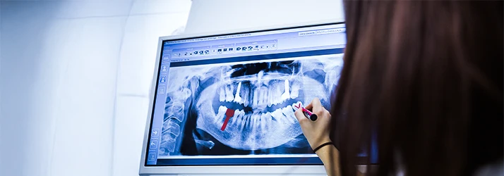 Oral surgeon analyzing dental implant placement on digital dental X-ray.