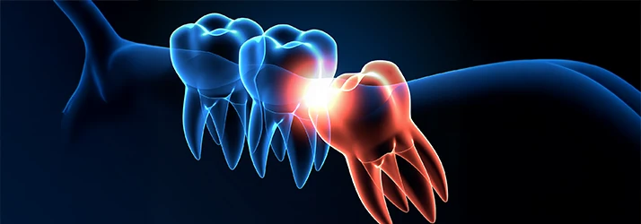 Illustration showing impacted tooth needing oral surgery intervention.