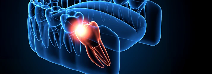 Illustration of an impacted wisdom tooth highlighting pain requiring oral surgery.
