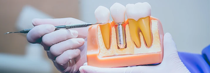 Periodontist demonstrating dental implant model. Periodontist demonstrating dental implant model.