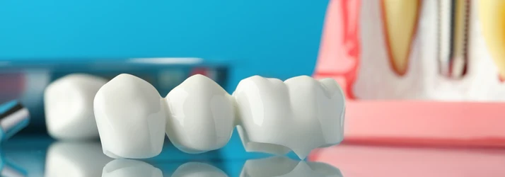 Dental Bridges in CITY* STATE*