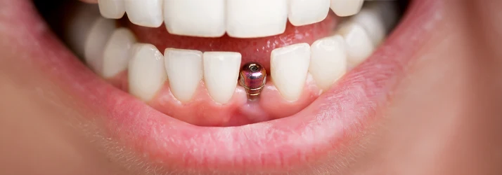 Dental Implants in CITY* STATE*