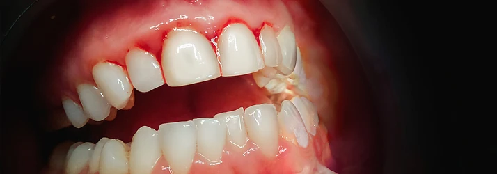 Gingivitis in Portland ME