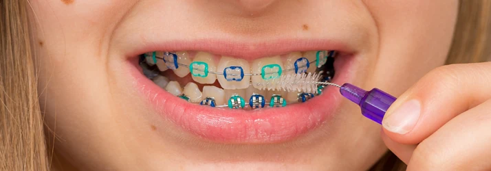How to Brush Teeth With Braces in Portland ME