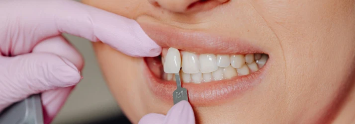 Veneers in CITY* STATE*