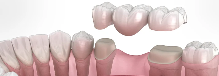 3D-Graphic-Showing-A-Dental-Bridge-Placement.webp