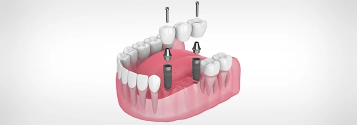 3D-Graphic-Showing-Dental-Implant-Anchors.webp