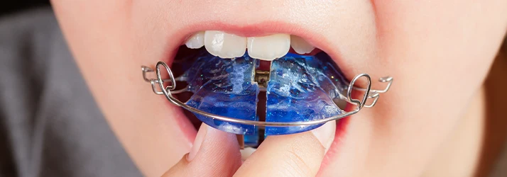 Close-Up-Of-A-Patient-With-A-Blue-Hawley-Retainer.webp