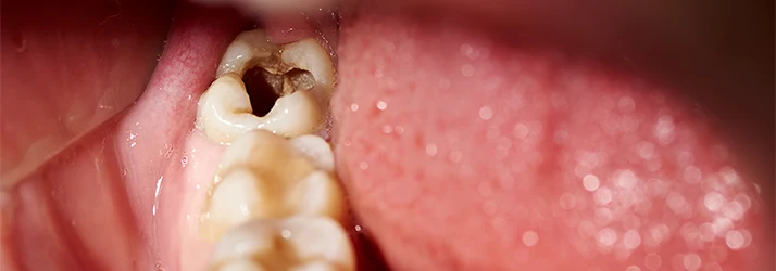 Close-Up-Showing-A-Cavity-In-A-Persons-Molar.webp