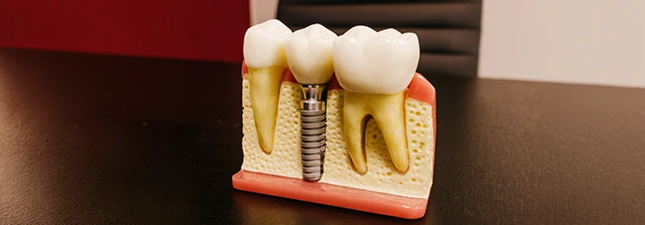 Cutaway-Example-Of-A-Dental-Implant-In-A-Jaw-On-A-Table.webp
