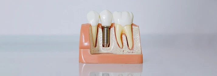 Cutaway-Example-Of-A-Dental-Implant-In-A-Jaw.webp