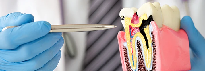 Doctor-Indicating-To-A-Model-Of-A-Tooth-With-A-Root-Canal.webp