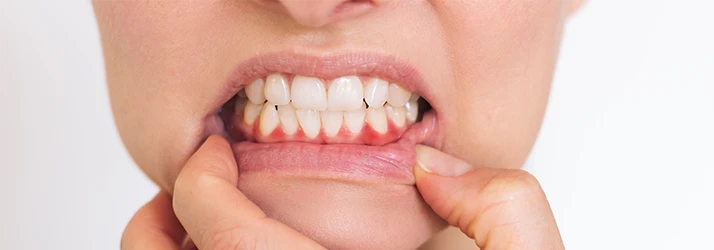 Person-With-Red-Infected-Gums-On-Grey-Background.webp